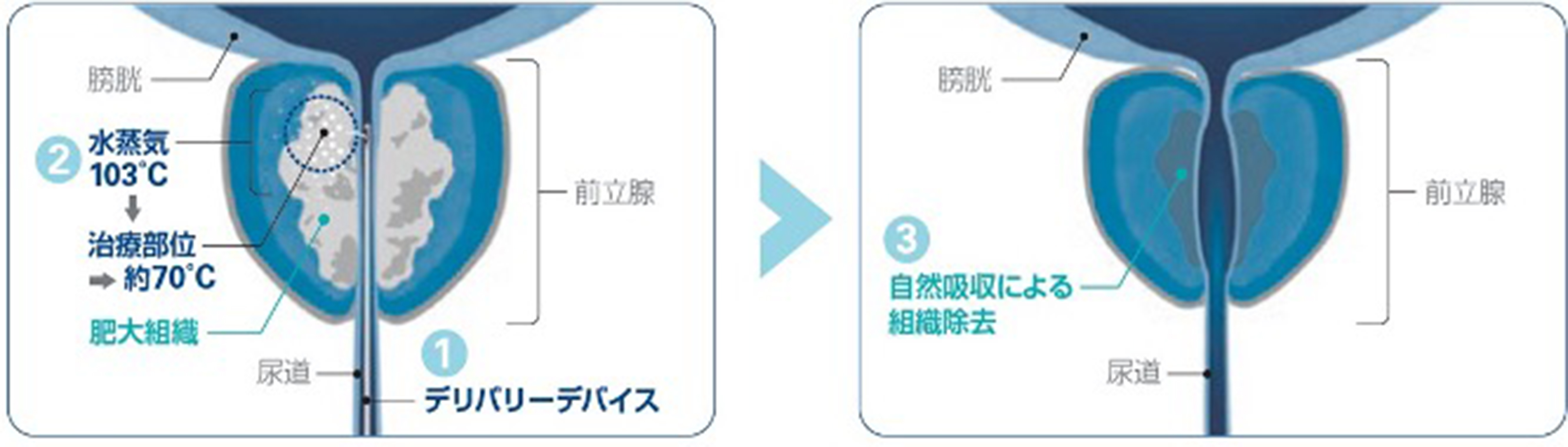 WAVE治療で水蒸気が前立腺組織に作用し自然吸収される仕組み